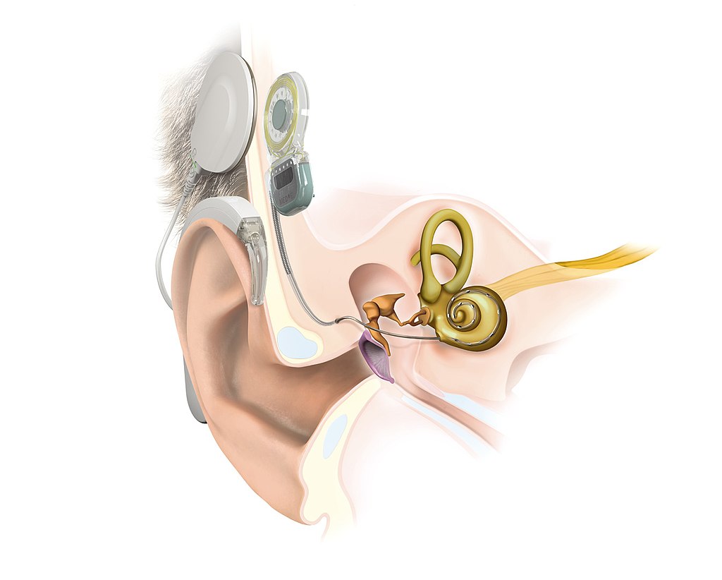 The processor and microphone sit behind the ear and are connected to a transmitter that attaches to the implant on the back of a person's head by a magnet. Tate and Mark can pull the transmitter off the sides of their heads if they don't want to hear anything -- say for sleeping or maybe to find a little relief from the extra work their brains have to do to decipher the sounds around them. The implant is connected to the cochlea -- the organ that creates the nerve impulses your brain translates into sound. The signal goes from the processor to the transmitter to the implant and is then sent directly to the auditory nerve through the cochlea in the inner ear.
<Hear hear!, CC BY-SA 4.0 https://creativecommons.org/licenses/by-sa/4.0, via Wikimedia Commons image
